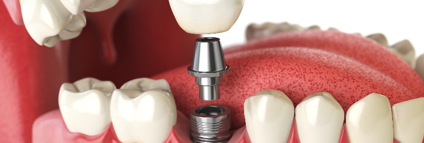 牙科材料检测